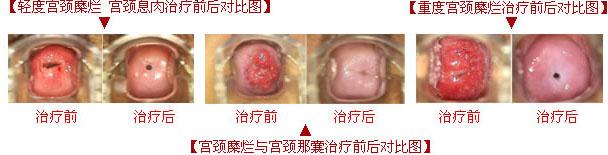 重度宫颈糜烂如何治疗 重度宫颈糜烂 重度宫颈糜烂如何治疗
