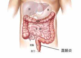妇科炎症并发症 妇科治疗 小心直肠炎并发症