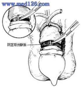 阴茎脱皮不痛不痒 阴茎 血管 不痛不痒 只要2个动作，每天做一次，肩不酸、颈不痛！血管更年轻！