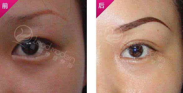 重睑术整形医院 重睑术整形医院 学生整形热 重睑术最火爆