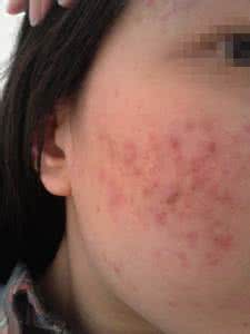 后背长痤疮怎么办 后背长痤疮怎么办 如何消除后背的痤疮