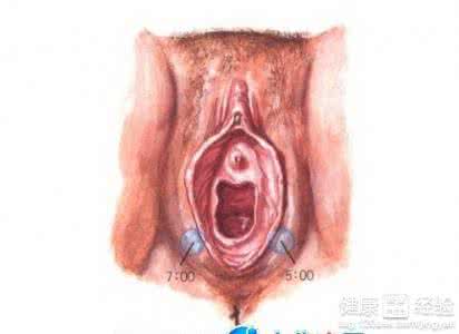 前庭大腺囊肿 前庭大腺囊肿 前庭大腺癌