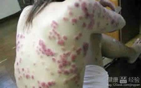 梅毒的诊断与治疗 梅毒 梅毒的治疗