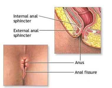 治疗肛裂最好办法 肛裂