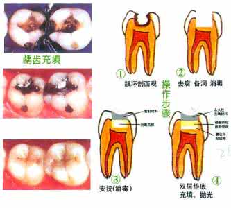 补蛀牙多少钱一颗 蛀牙简介