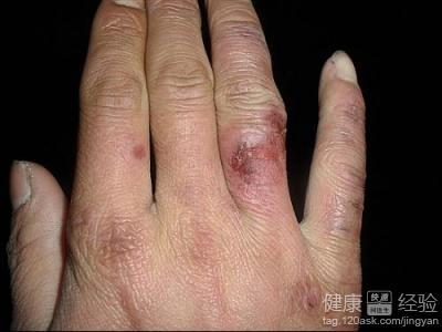 手癣偏方简单有效 治疗灰指甲、手癣等有效又廉价的偏方