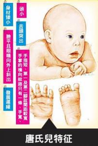 小儿唐氏综合征 小儿唐氏综合征 哪些夫妻容易生出唐氏综合症儿童