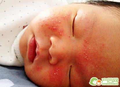 湿疹有哪些症状表现 湿疹有哪些症状表现 宝宝湿疹的症状表现有哪些呢？