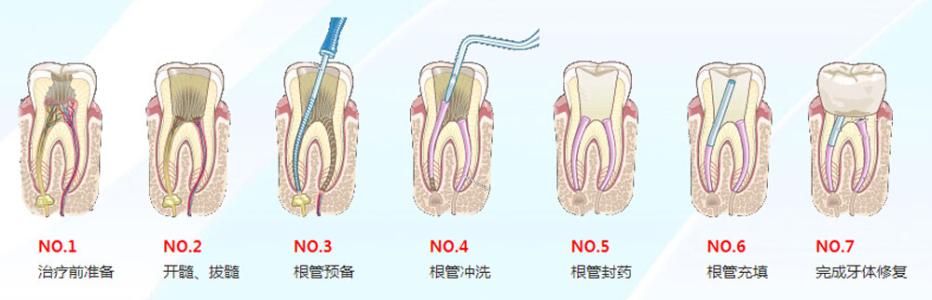 无痛根管治疗 有无痛根管治疗吗？