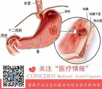 什么样的胃病容易癌变 胃病癌变 如何识别胃病癌变信号?