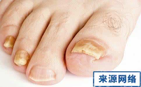 治疗脚气的药jiaoqi8 终于找到真正治疗脚气的药了