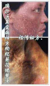 瑞尔黑变病 祖传秘方:瑞尔氏黑变病神方枸杞菊花地黄汤