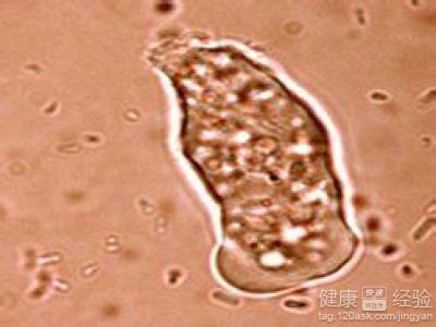 细菌性痢疾的治疗 细菌性痢疾 细菌性痢疾该怎么治疗