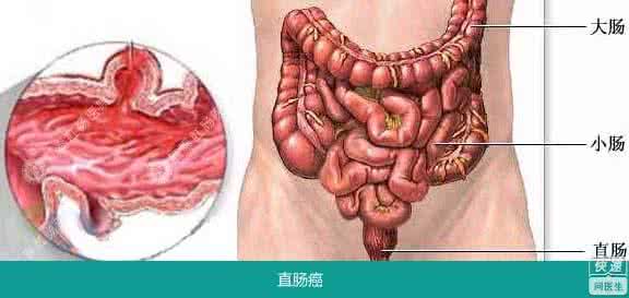 原始点治疗肺癌 原始点处理好的直肠癌、肺癌案例