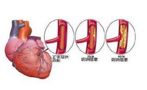 冠心病临床症状 冠心病的五个临床症状表现