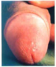 女性尖锐湿疣症状 它有哪些症状