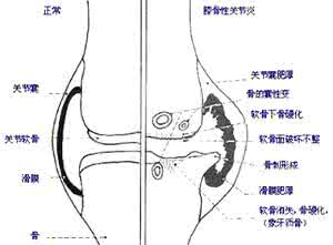 中医类风湿性关节炎 中医类风湿性关节炎 类风湿性关节炎中医治疗大全