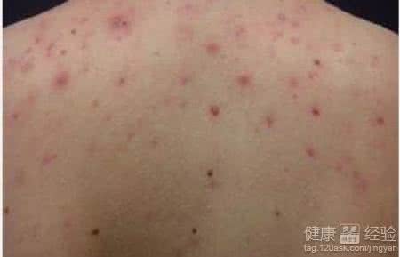 背部痤疮的治疗方法 医治背部痤疮什么方法 怎么医治呢
