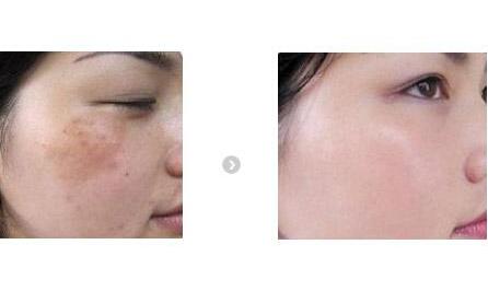 激光祛斑 激光祛斑 激光祛斑十步走