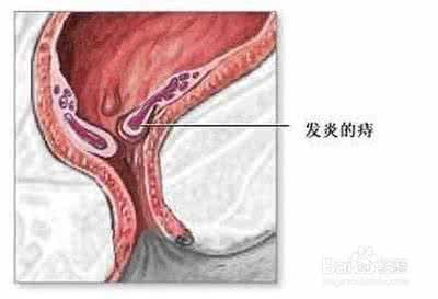 治内痔疮大便出血 内痔便血怎么办 痔疮大便出血怎么办