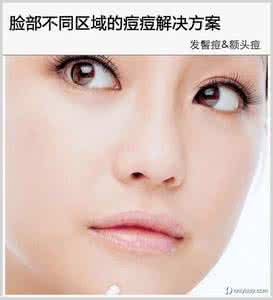 治疗脸部痘痘的方法 治疗脸部痘痘 脸部不同区域的痘痘解决方案