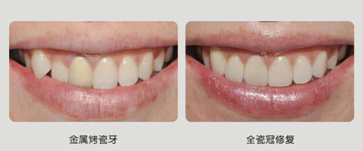 拔牙后做烤瓷牙 拔牙 装个烤瓷牙多少钱