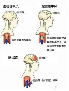 出血性脑卒中 出血性脑卒中 一图读懂丨出血性脑卒中 VS 缺血性脑卒中