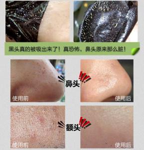 脸上螨虫是什么样的 黑头和螨虫的区别是什么