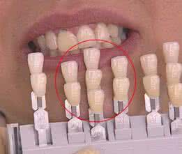 牙齿什么颜色最健康 什么颜色的牙齿最健康