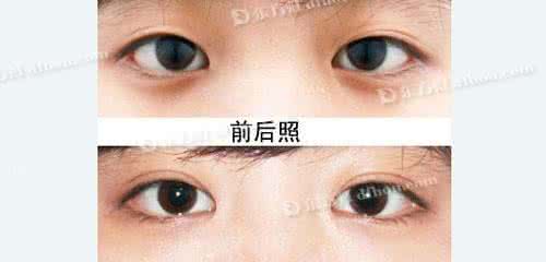 双眼皮修复需要多少钱 双眼皮修复需要多少钱 修复双眼皮也需要掐指一算