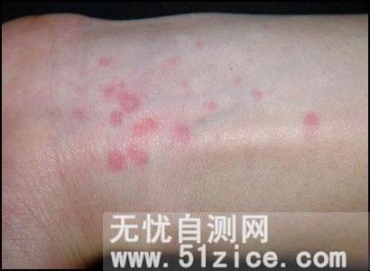 得艾滋病的前兆 艾滋病图片女人前兆 如何自我检测艾滋病 艾滋病前兆