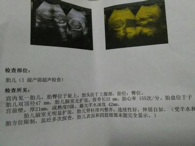 怀孕要做多少次b超 孕期做多少次b超 整个孕期到底要做多少次B超检查?