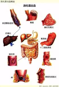 消化道出血的4大病因 消化道出血的预防 消化道出血5大治疗方法