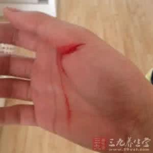 慢性结肠炎怎么治疗好 慢性结肠炎的治疗 这样治疗慢性结肠炎好