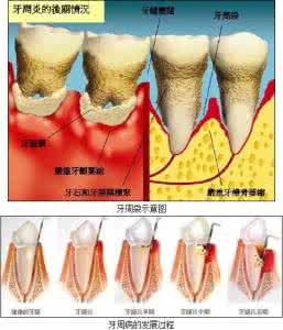 牙周病 牙周病与消化系统疾病 孕前应处理好牙病等疾病