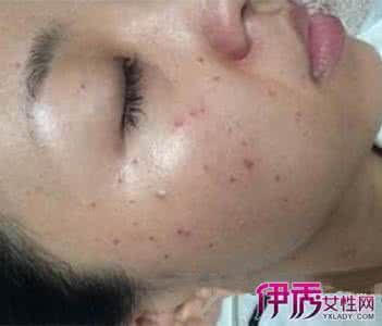 嘴边长痘痘是什么原因 扁皮尤 嘴周围长痘痘的原因