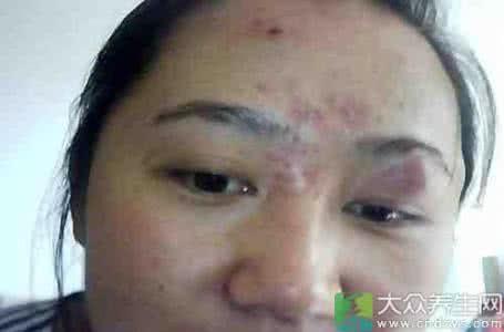 脸上长脓包怎么处理 脸上长脓包 怎么处理脸上长脓包