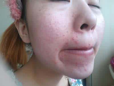粉刺和痘痘的区别 脸上粉刺真讨厌 3大对策痘痘不见