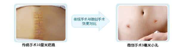 宫外孕的早期症状 症状:宫外孕的症状