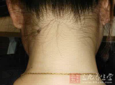 弥漫性丘疹 弥漫性丘疹 这种病症应该这样治疗