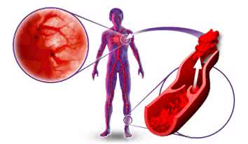 羊水栓塞的原因 肺栓塞偏方 羊水栓塞的偏方