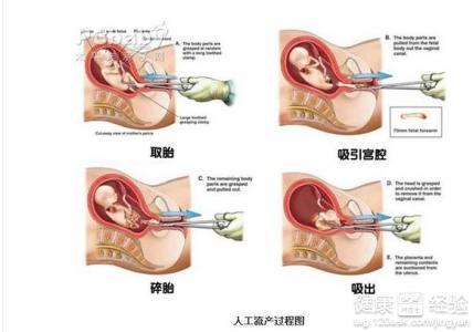 无痛人流手术过程图 无痛人流全过程 无痛人流手术全过程（图）