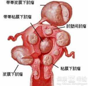 子宫肌瘤的症状表现 子宫肌瘤的症状表现 子宫肌瘤都有哪些表现症状
