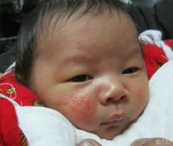新生儿皮肤病 新生儿最容易被侵扰3种皮肤病
