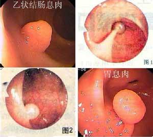 胆囊息肉吃什么药好 胆囊息肉菜花样吃些什么好