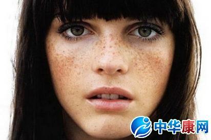 雀斑和黄褐斑的区别 黄褐斑和雀斑的区别 解决斑点困扰