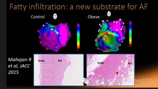房颤治疗新进展 房颤治疗新进展 减肥或逆转肥胖人群房颤进展