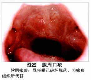 复发性阿弗他口腔溃疡 口腔解毒汤治疗复发性阿弗他溃疡临床疗效观察