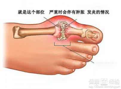 骨质增生的治疗偏方 偏方如何治疗骨质增生