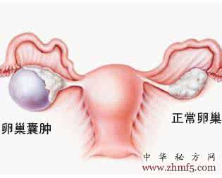 双侧卵巢囊肿怎么办 卵巢囊肿怎么办？究竟什么是卵巢囊肿？